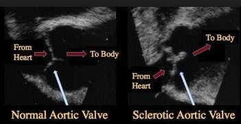 Aortic Stenosis Aortic Sclerosis