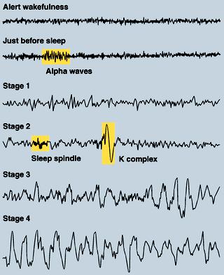 EXAMPLES OF EEG ACTIVITY - Awake: low voltage, random, fast beta waves - Drowsy: 8-12 Hz alpha waves - Stage 1: 3-7 Hz theta waves - Stage