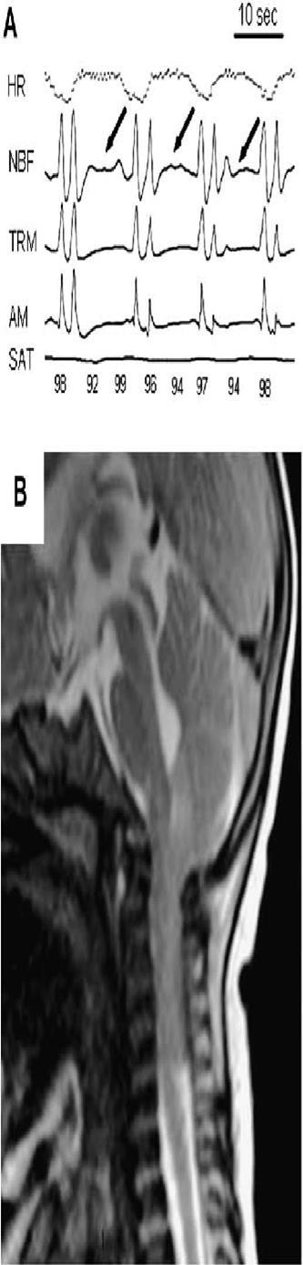Chiari Malformations Herniations of Cerebellum or brainstem through Foramen magnum May present