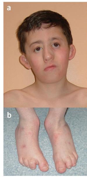 Miller Syndrome Cupped ears coloboma of the lower eyelids, prominent nose, micrognathia absence of the fifth digits