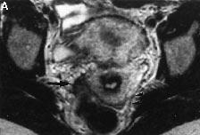K.Kinkel et al. Figure 1. Deep endometriosis of the right uterosacral ligament (USL) extending to the rectal wall muscles in a 32 year old woman.