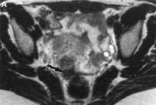 (A) Axial T2-weighted image obtained with the body coil and (B) axial T2-weighted image obtained with an endorectal cervix coil in endovaginal position (small arrow) show a hypointense nodule (arrow)