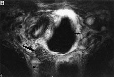 Irregularity with presence of a proximal nodule on a uterosacral ligament was highly indicative of deep endometriosis. Two lesions of uterosacral ligaments extended to the rectal muscularis propria.