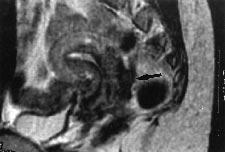 MRI of deep endometriosis Lesions of the rectum (n 3) Two patients complaining about tenesma presented with three nodules of deep endometriosis of the rectal wall at pathology.
