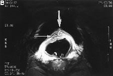 Six of the seven patients underwent preoperative transvaginal ultrasound misdiagnosing a subserosal anterior fibroid of the uterus (n 2) or a bladder tumour (n 4).