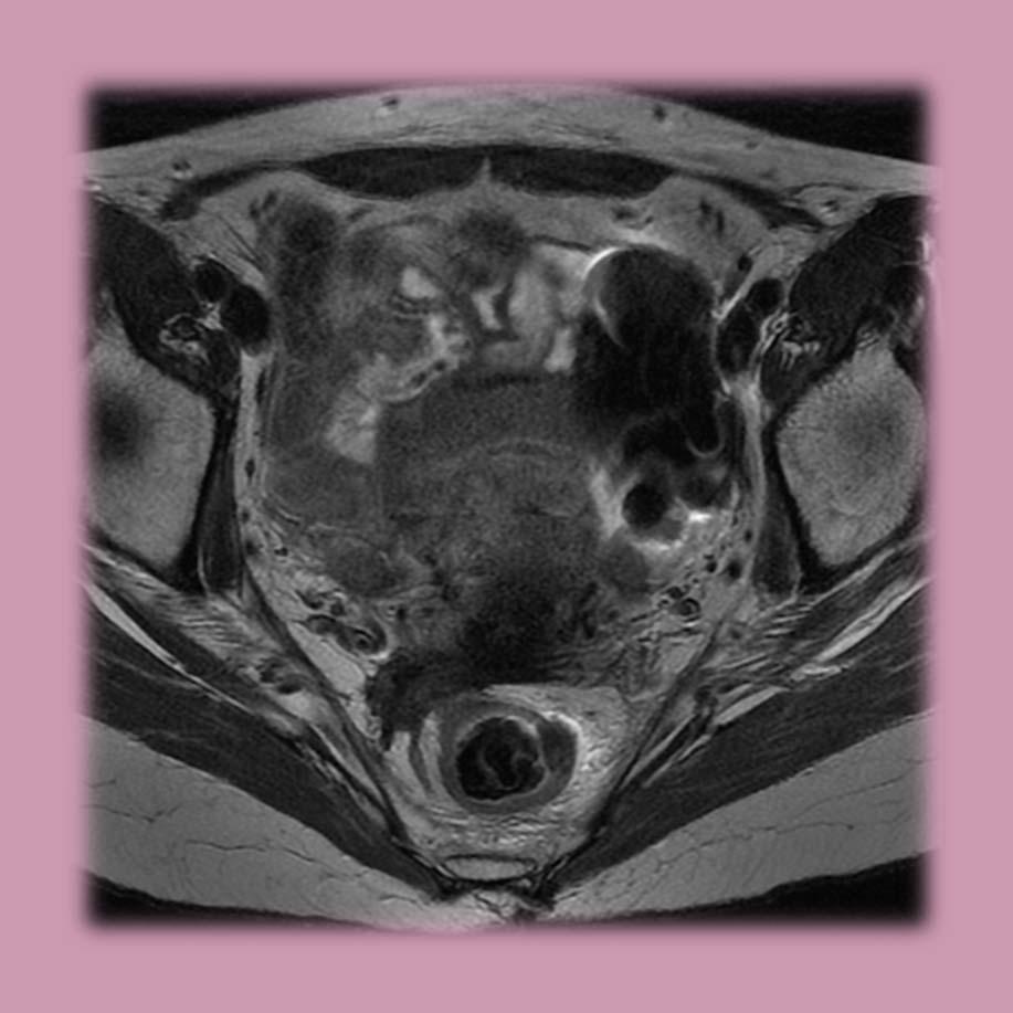 Endoscopyangiodysplasias of the rectum argon plasma