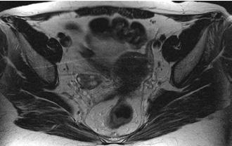 the torus uterinus,  ligament