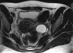 hemorragic left ovarian cysts and adhesion with