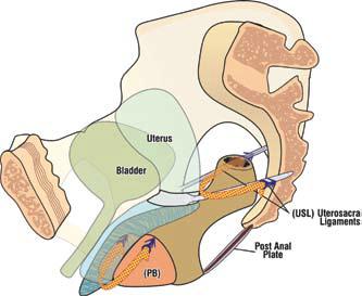 uterosacral (USL) ligaments and fascia with a posterior tape. Fig. 14. TFS repair of rectocele.