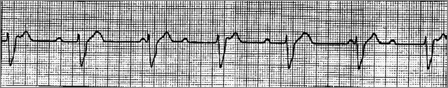 : QRS complexes IDENTIFYING FEATURES: o PR Interval increases until there is a dropped QRS complex after a P-wave.