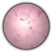 Mycobacterium tuberculosis Acid fast bacterium (AFB) Reproduces very slowly delays in laboratory
