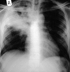 Diagnosis X-ray is how we screen applicants for TB Migrants who have a positive finding on Chest x-ray