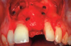This approach involves a low rate of complications in the presence of appropriate soft-tissue management, the use of microinstruments, and thanks to the good biocompatibility of the resorbable