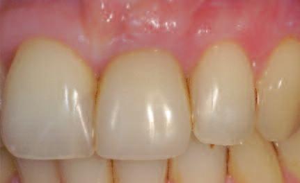 Summary Patients aesthetic demands have become the main criterion by which to judge the achievements of modern dental implantology.