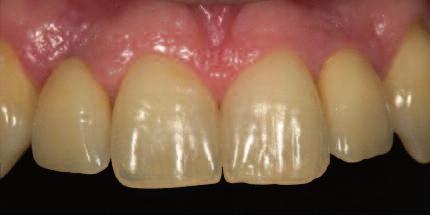 At sites of congenitally missing lateral incisors, for example, the horizontal bone dimension is usually inadequate.