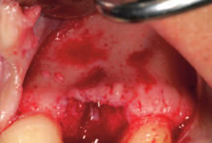 A common cause is the occurrence of subacute inflammatory processes in endodontically treated teeth with vertical root fractures (Figures E1 E4).