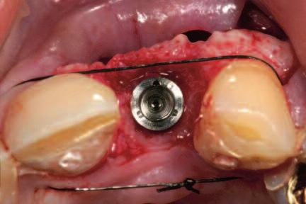 When the defect was exposed six weeks after tooth extraction, a well-circumscribed three-dimensional bone defect became evident both in the