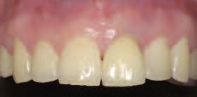 In the presence of major bone defects, the mandibular angle is an appropriate harvesting site, which, if anatomical conditions are
