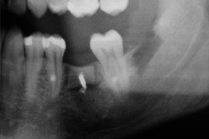 Engaging the mandibular border with the instrument carries a risk of contour alterations and has to be strictly avoided.