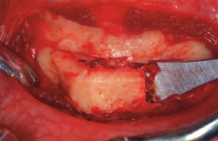 Failure to do so can lead to local wound dehiscence, unpleasant scarring or even contour alterations (Figure SY1).