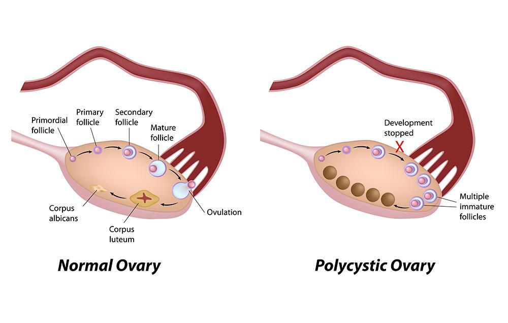 PCOS: polycys=c ovary/ovaries syndrome haps://www.
