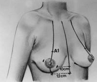 Of the 325 women who received the inverted-t incision, 114 had this pectoral flap, and of the 396 patients who received the lateral oblique incision, 174 had the flap.