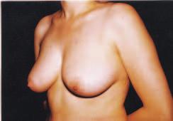 A B C D Figure 14. A and C, Preoperative views of a 43-year-old woman with mammary flaccidity.