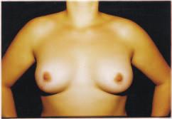 Three hundred twenty-five women received an inverted-t mammaplasty.