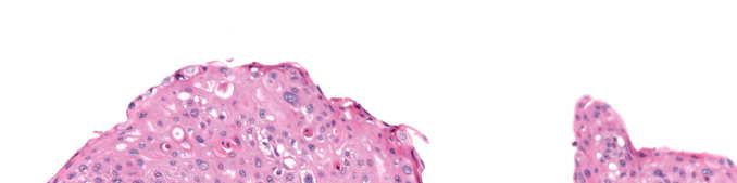 types: Squamous cell carcinoma