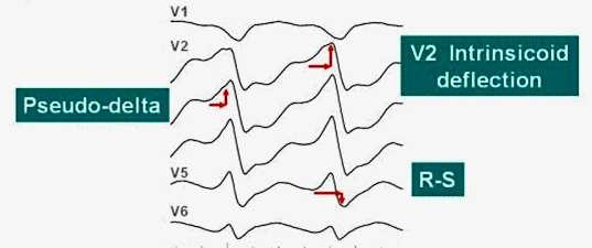ECG Recognition of Epicardial VTs ECG features suggesting Epicardial VT: Pseudodelta wave: 34 msec from QRS onset to beginning of earliest rapid deflection in V1-V6 Intrinsicoid
