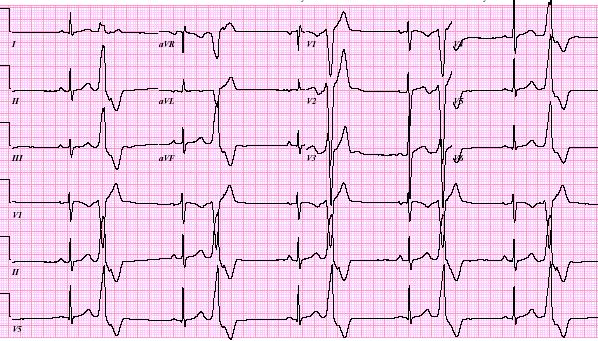 Outflow tract PVCs 30 y/o M with frequent PVCs since age 10, DCM progressive since
