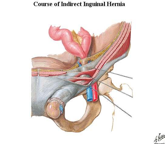 4- Contents of Hernia is normally in front of the cord contents 1- The Neck is Usually Narrow 2-