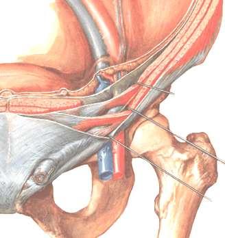Inguinal canal: Deep inguinal ring Fascia Transversalis Oblique canal Extends from