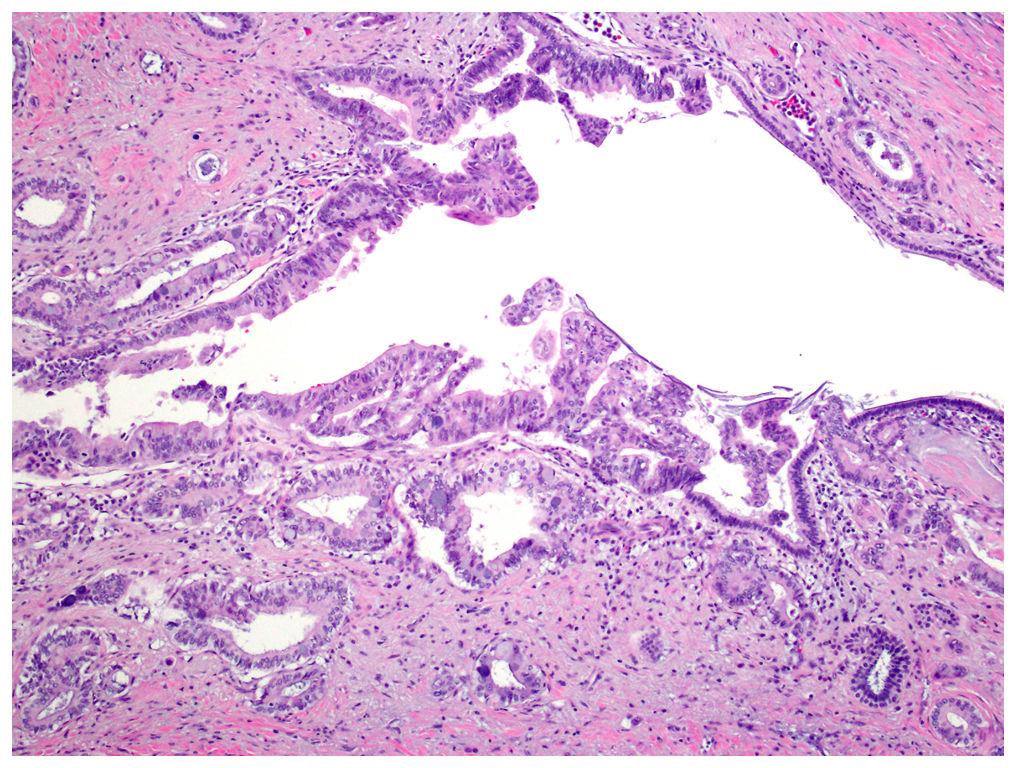 Basturk et al. Page 22 Figure 5. Intraductal spread of invasive carcinoma. Highly atypical epithelia undistinguishable from invasive carcinoma line a duct.