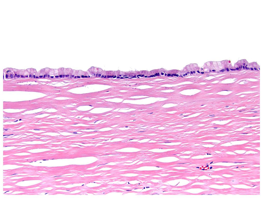 Basturk et al. Page 23 Figure 6. Macroscopic cyst with flat mucinous lining.