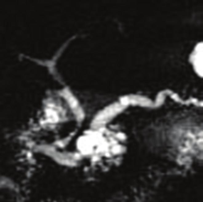 The boundary between the main pancreatic duct and the cystic components of branch ducts disappears. (d) MRCP in 2006. Filling defects in the main pancreatic duct are visible (arrow).