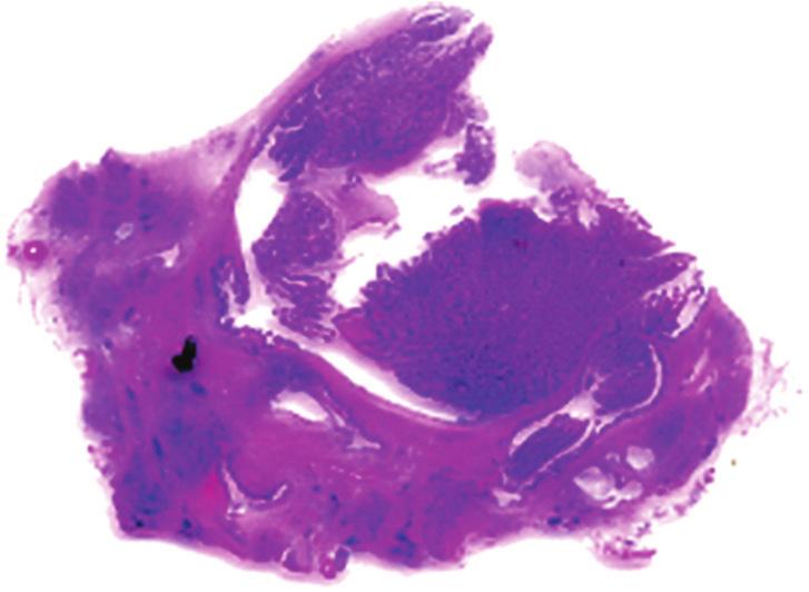 (f) Figure 2: (a) Resected specimens show marked dilation of the main pancreatic duct and