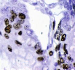 gastric-type adenoma components showed focal and thin staining both in the MPD