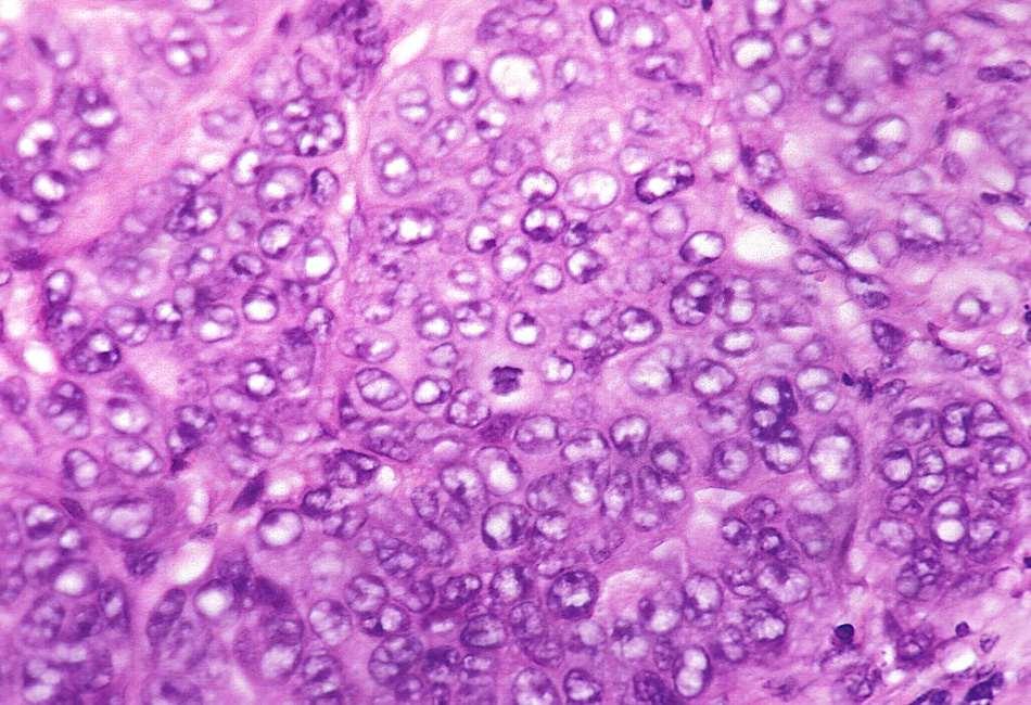 Poorly-differentiated, grade III (3+3+3) tumor no