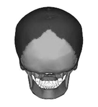 Parietal bone LOD: Inferior Occipital Bone
