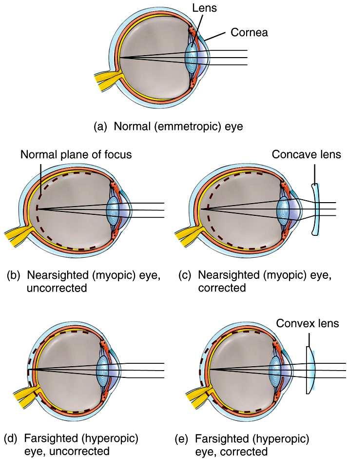 Refraction abnormalities and their correction Nearsightedness (myopia)- close objects are seen clearly. Image is focused in front of the retina.