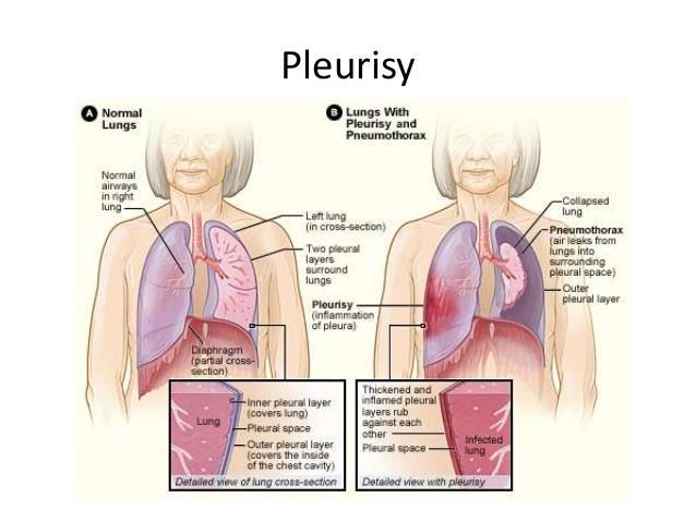Pleurisy Pleurisy, also known as pleuritis, is inflammation of the membranes (pleurae) that surround the lungs and line the chest cavity. This can result in a sharp chest pain with breathing.