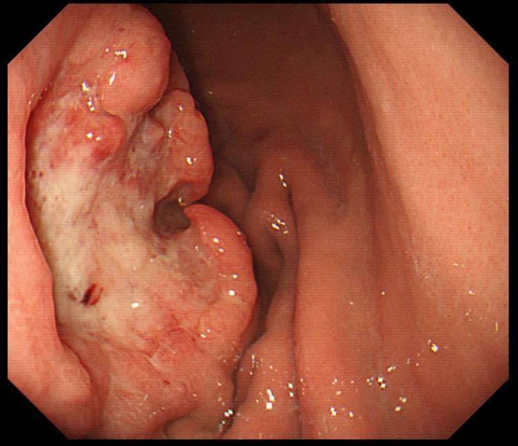 Figure 1. An upper gastrointestinal endoscopy shows a type 2 tumor measuring approximately 70 mm in the anterior wall of the lower gastric body Figure 2.
