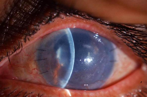 82 H. Alkatan et al. Figure 1a. An example of primary graft failure in the left eye. Figure 2b.