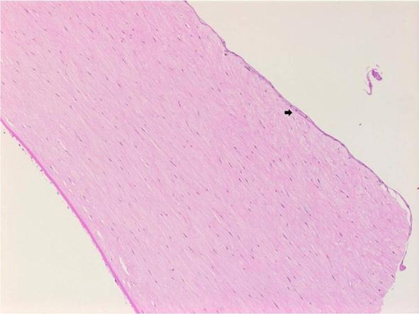 Histopathological findings of failed grafts following 83 Figure 4a. Epithelial ingrowth (arrow) at the graft host interface of specimen 7 (hematoxylin eosin, original magnification 200). Figure 5b.