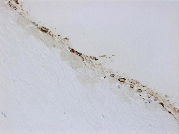 Figure 6. Stromal amyloid deposits within the stroma (Congo red, original magnification 200). Figure 5a.