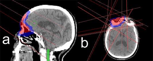 103 Karotki et al.: Electron density for MRI planning 103 Fig. 2. Treatment beams arrangement in sagittal (a) and axial (b) planes for patient #7.