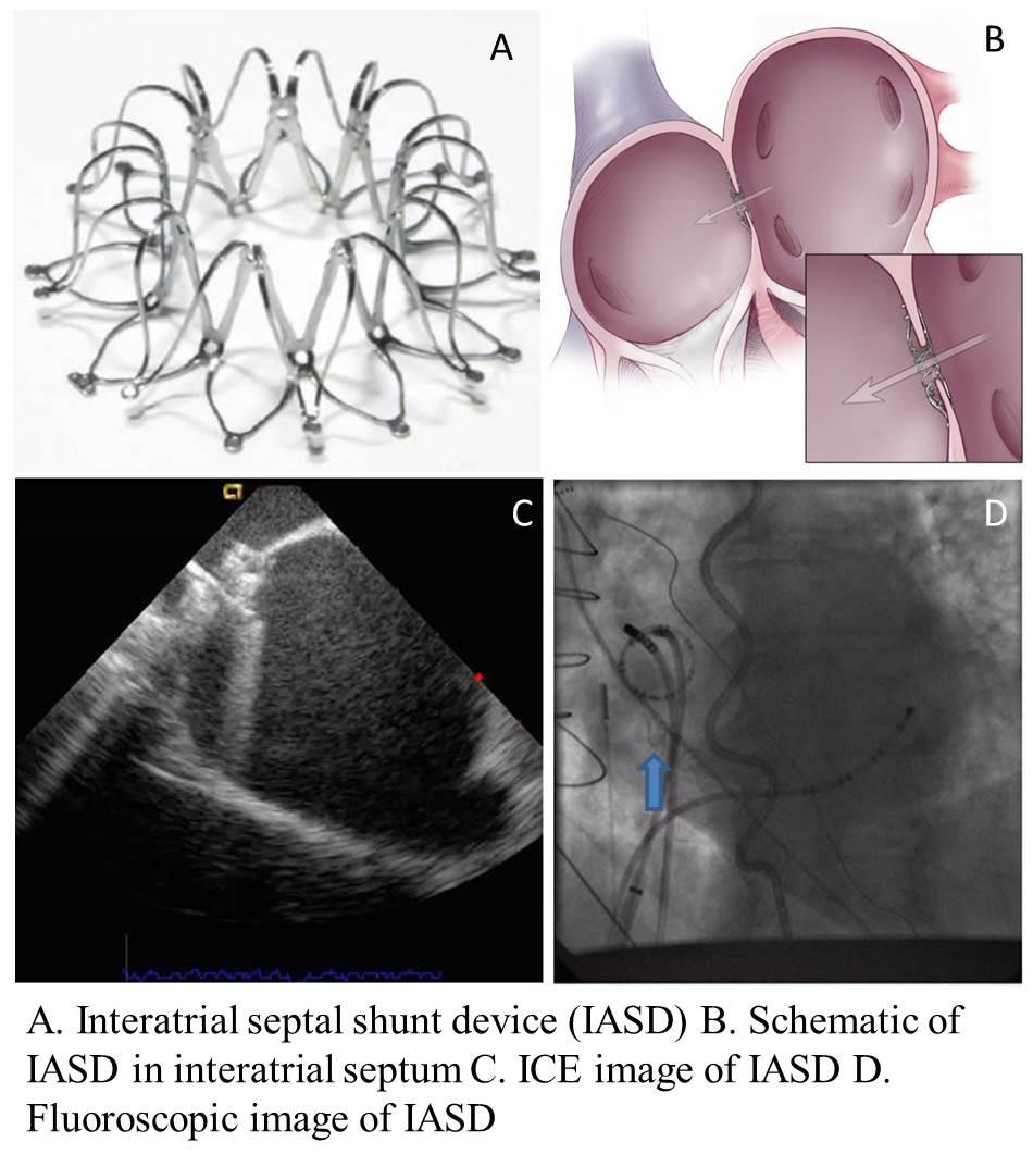 typically due to a Thebesian valve or anatomic variants of the coronary sinus.