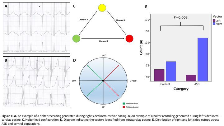 S574 Heart Rhythm, Vol. 15, No. 5, May Supplement 2018 tetralogy of Fallot (3), dtga s/p Mustard (2), dtga/vsd s/p arterial switch (1), complex VSD (1) and Ebstein s anomaly (1).