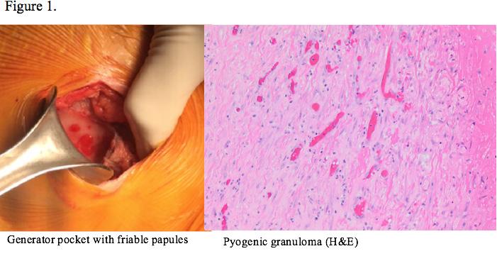 B-PO05-218 REACTIVE PYOGENIC GRANULOMA FORMATION RELATED TO SUBCUTANEOUS IMPLANTABLE CARDIOVERTER DEFIBRILLATOR Benjamin C. Salgado, MD and Brad S. Sutton, MD, MBA, FHRS.